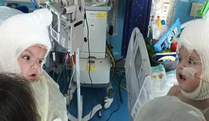 Σιαμαία που ήταν ενωμένα στο κεφάλι βλέπουν για πρώτη φορά το ένα το άλλο [εικόνες]