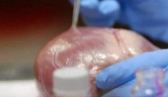 Επιστήμονες δημιούργησαν κόλλα που επουλώνει πληγές στο σώμα