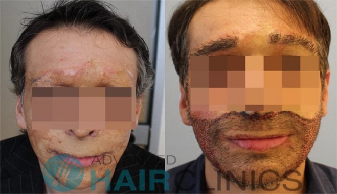 ΝΕΟ πρόσωπο σε 34χρονο δημιούργησαν Έλληνες επιστήμονες