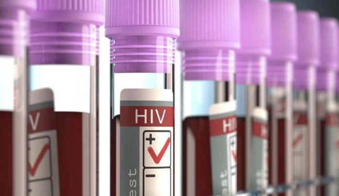 AIDS: Πρωτοφανή αποτελέσματα από νέα θεραπεία – Η περίπτωση 44χρονου Βρετανού